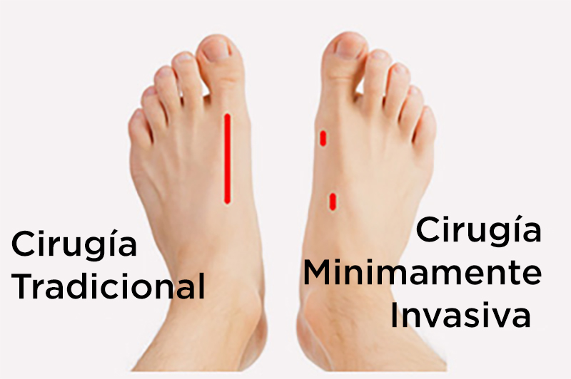 Cirugía minimamente invasiva en pie y tobillo - Costa Rica - Dr. Lisandro Jiménez y Dr. Oscar Castro Aragon.