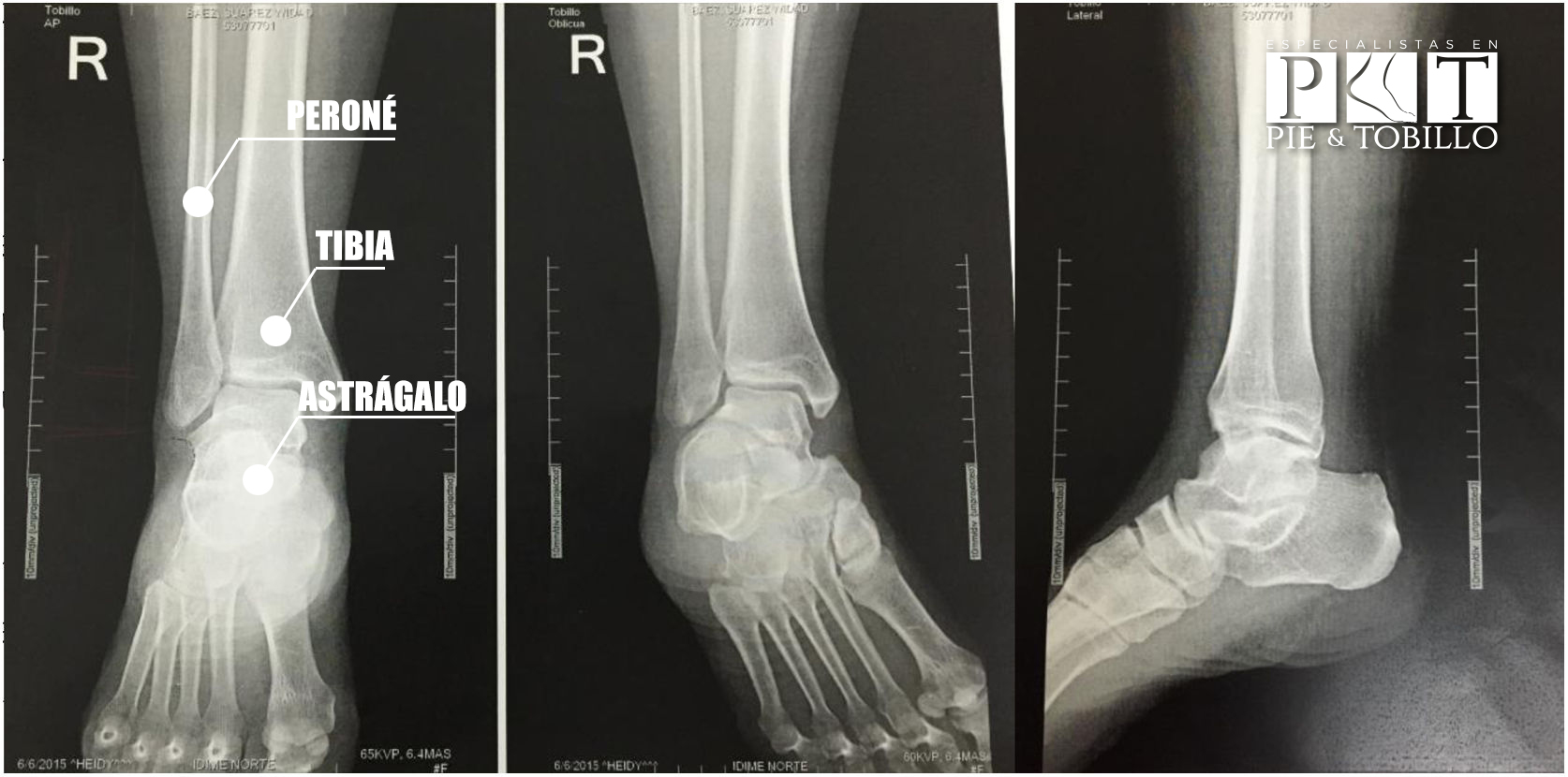 Huesos del tobillo: Tibia, Peroné, astrágalo. Especialistas en Pie y tobillo en Costa Rica.